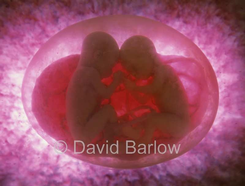 Twin 24 week foetus's sharing a single placenta and amnion